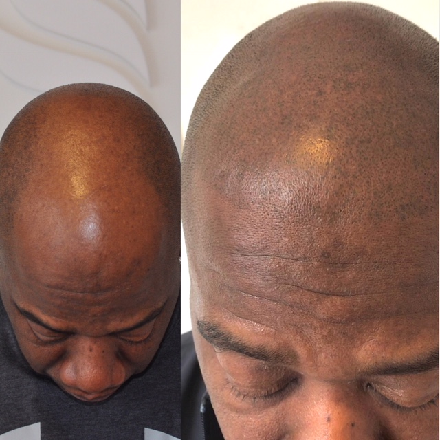 permanente make up scalp pigmentatie